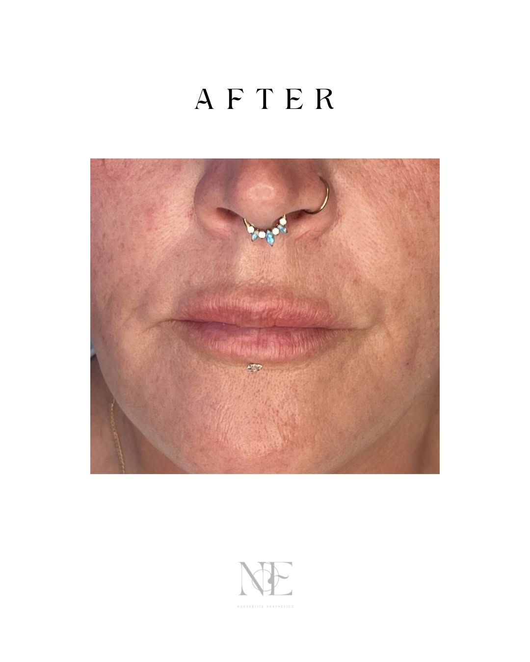 Nasolabial folds — after