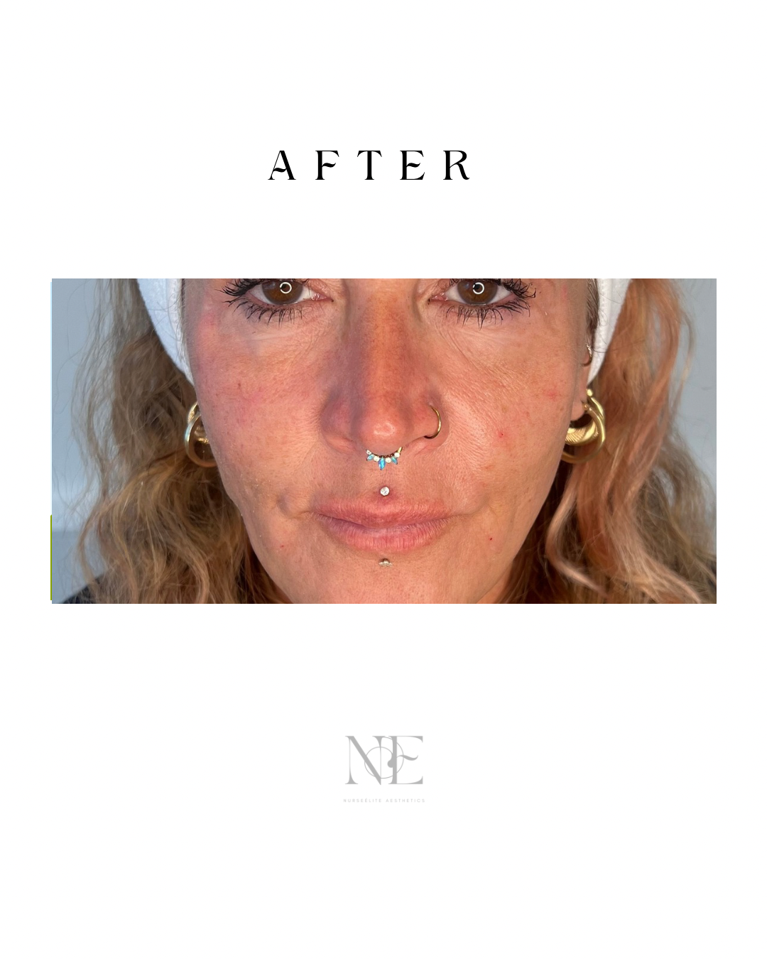 Cheek enhancement — after