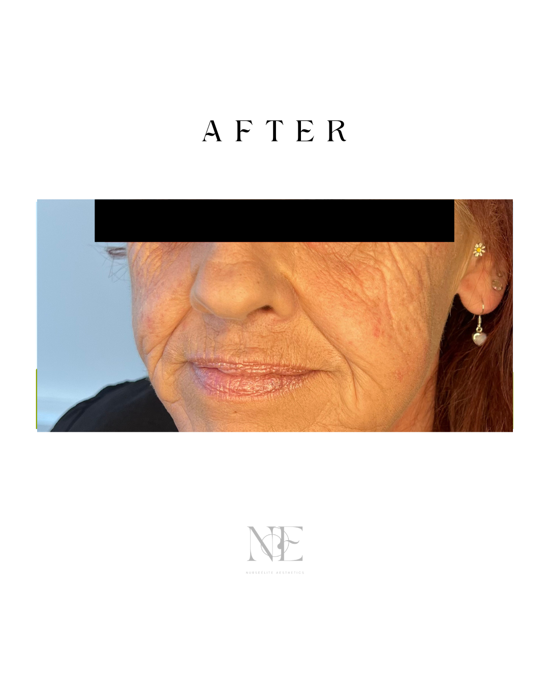 Cheek enhancement — after