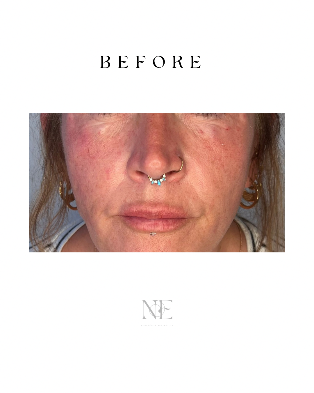 Cheek enhancement — before