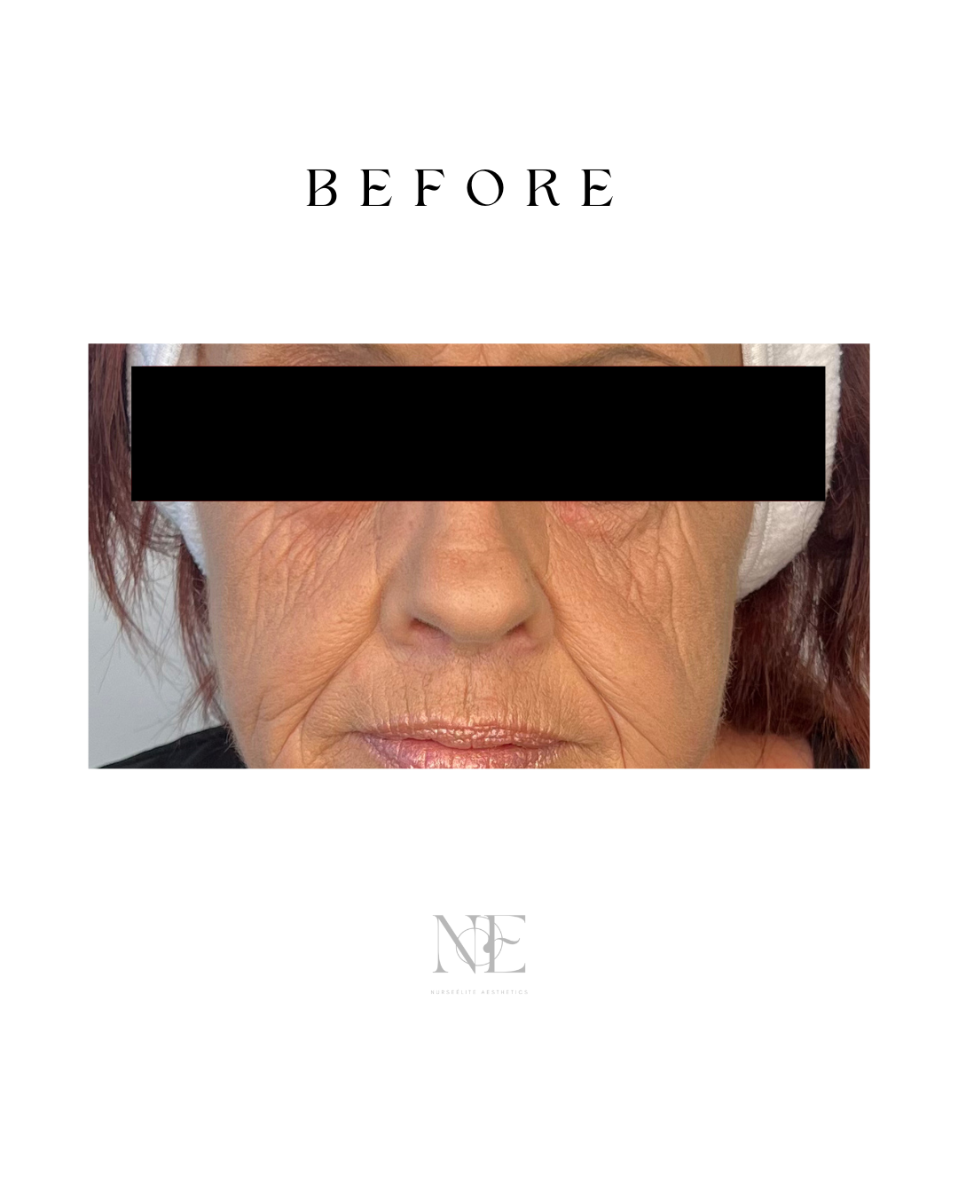 Cheek enhancement — before