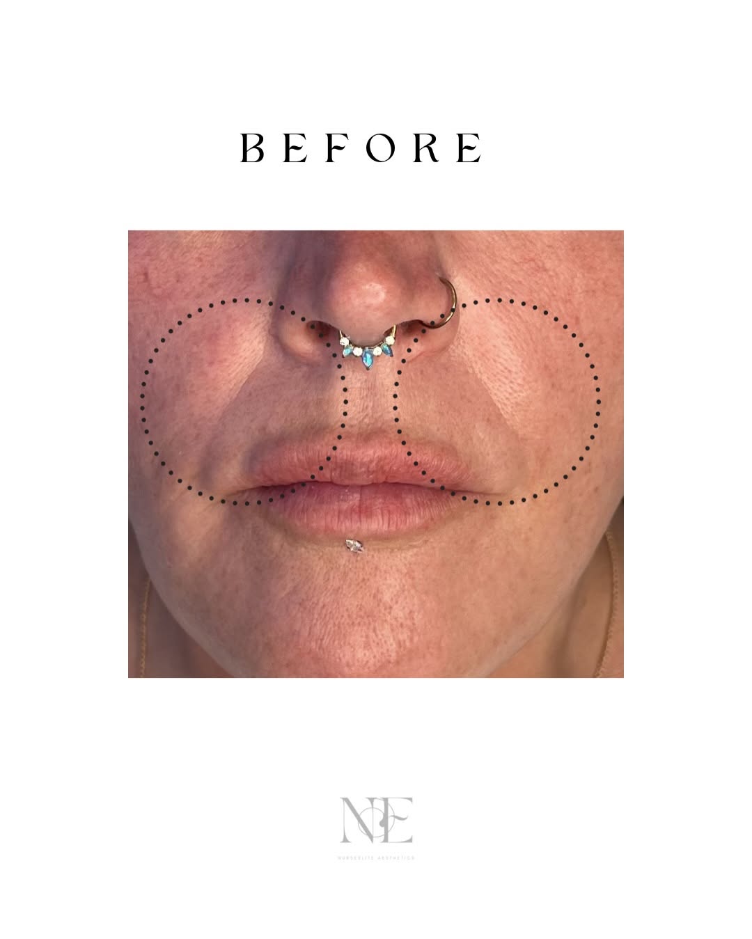 Nasolabial folds — before