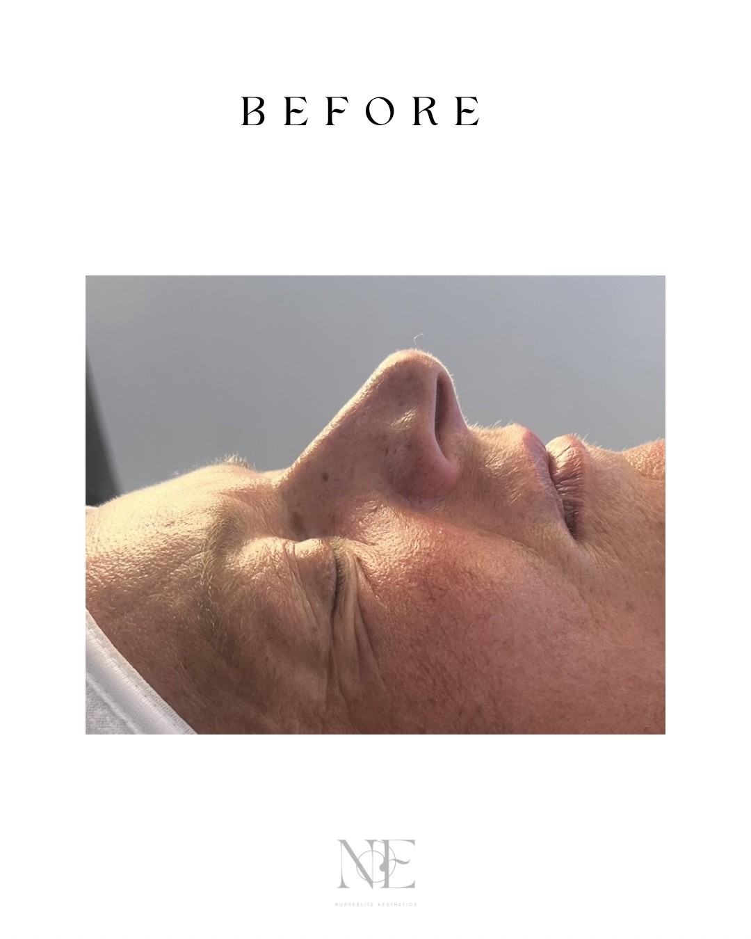 Nose augmentation — before