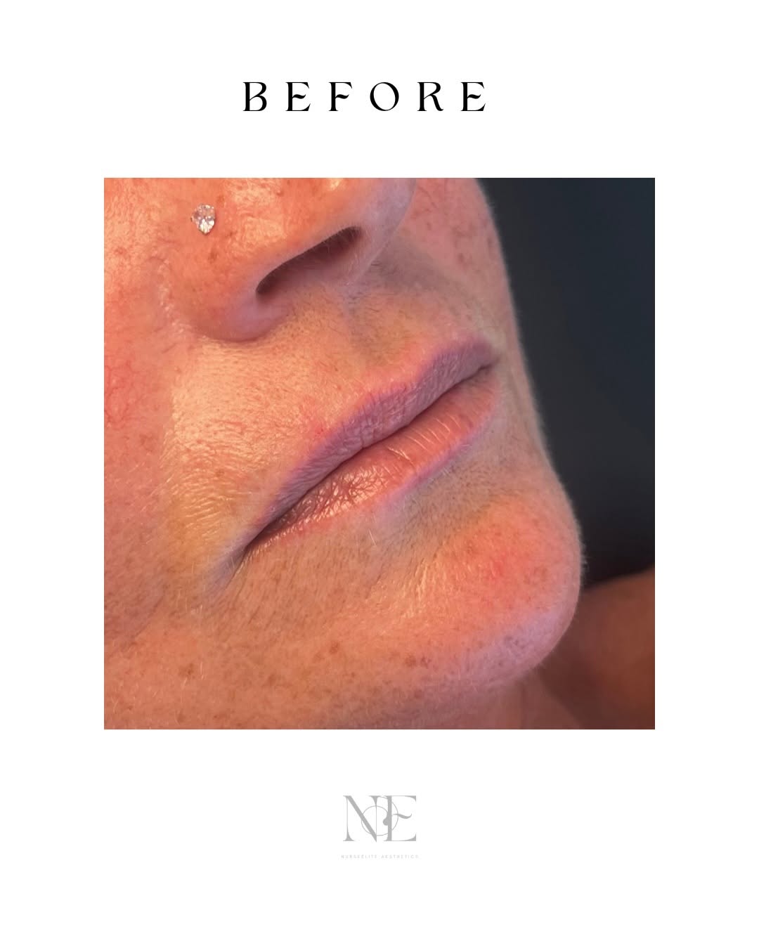 Lip filler — before