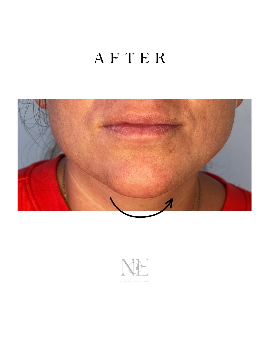 Chin augmentation — after