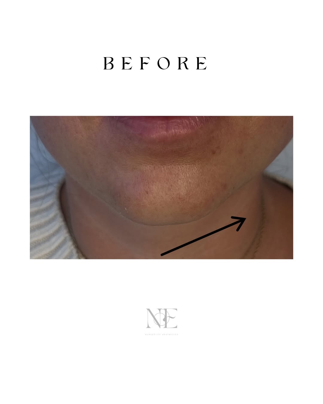 Chin augmentation — before