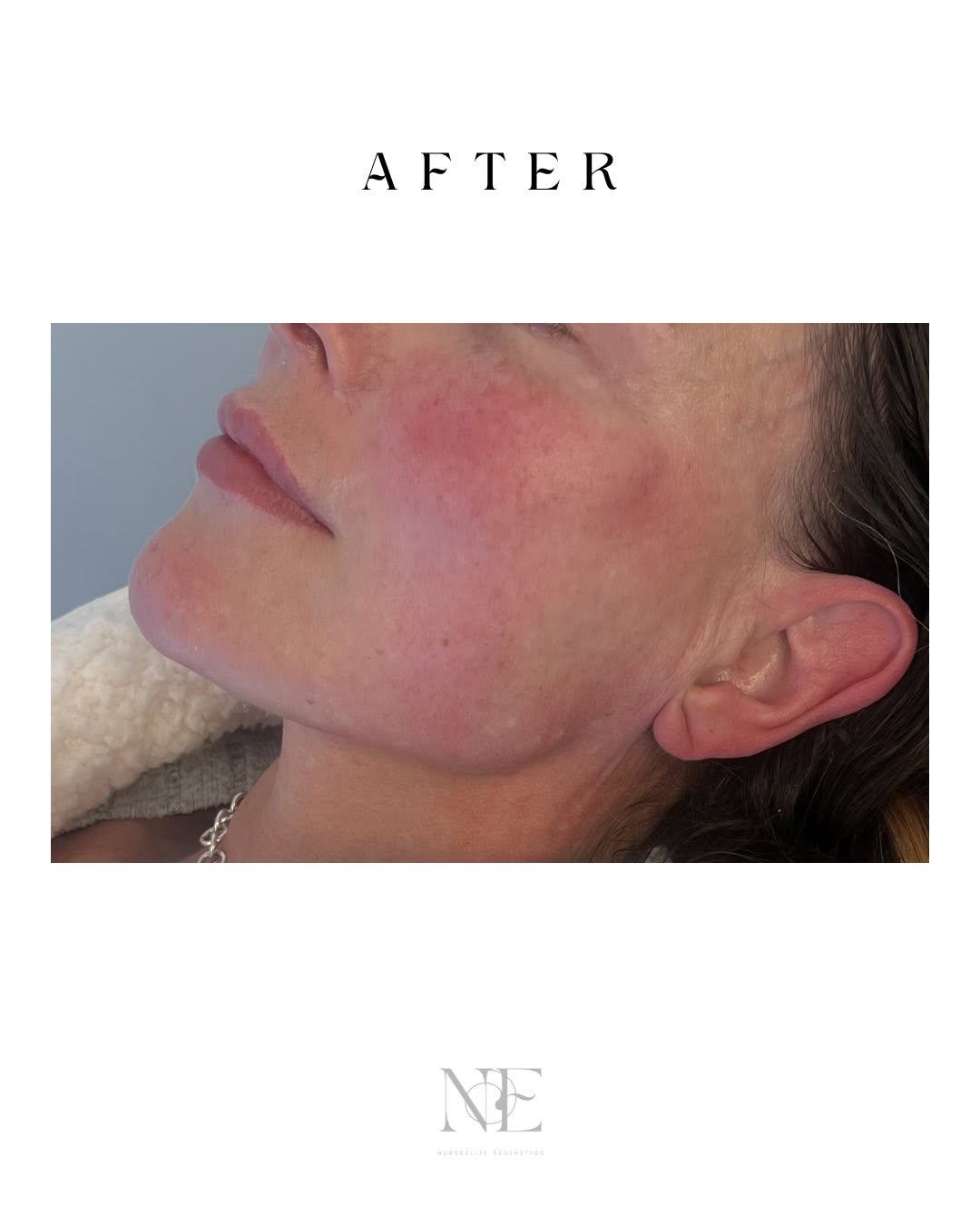 Jawline augmentation — after