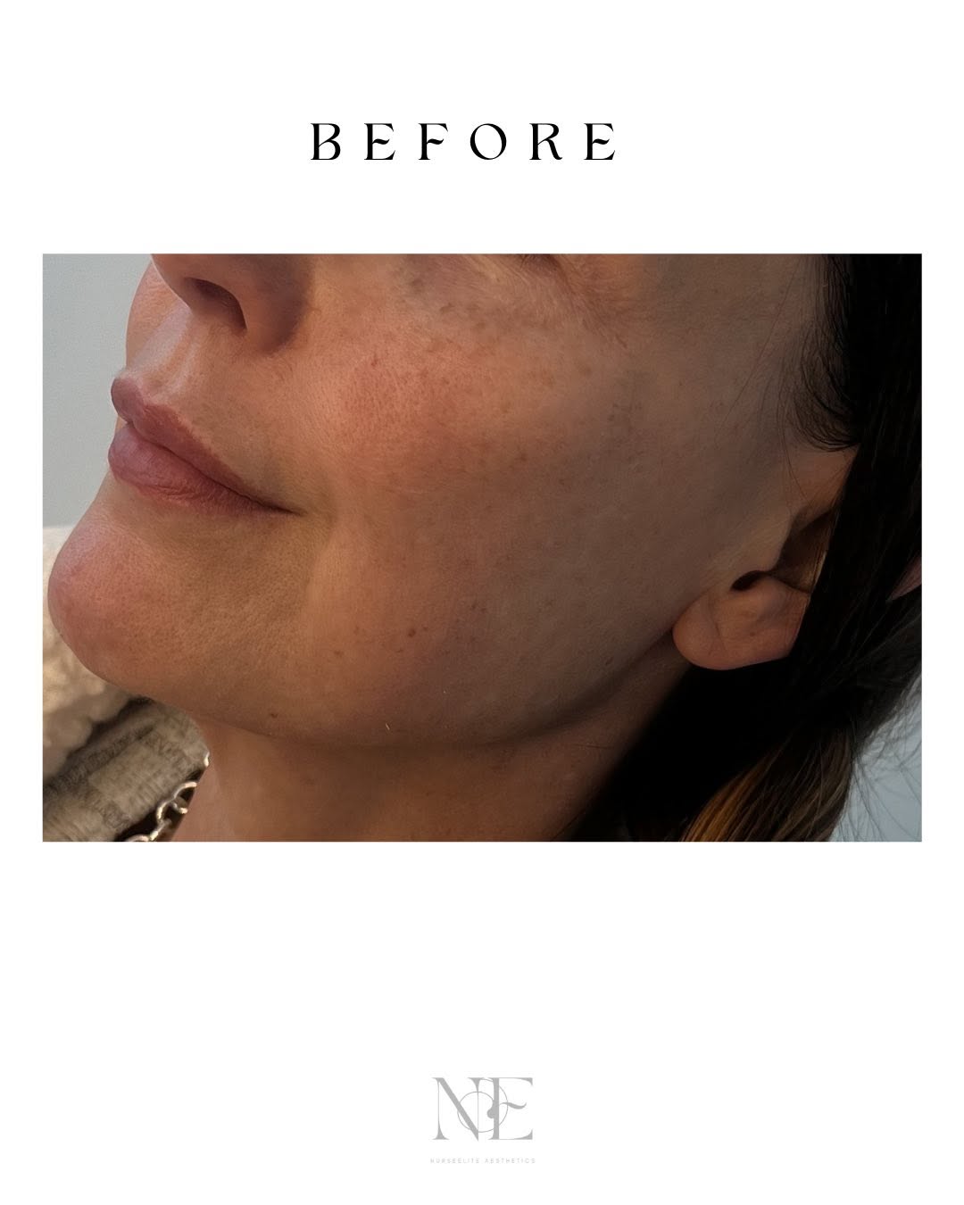 Jawline augmentation — before