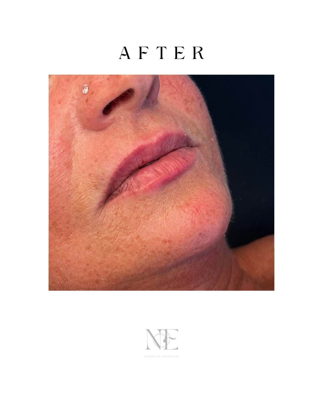 Lip filler — after