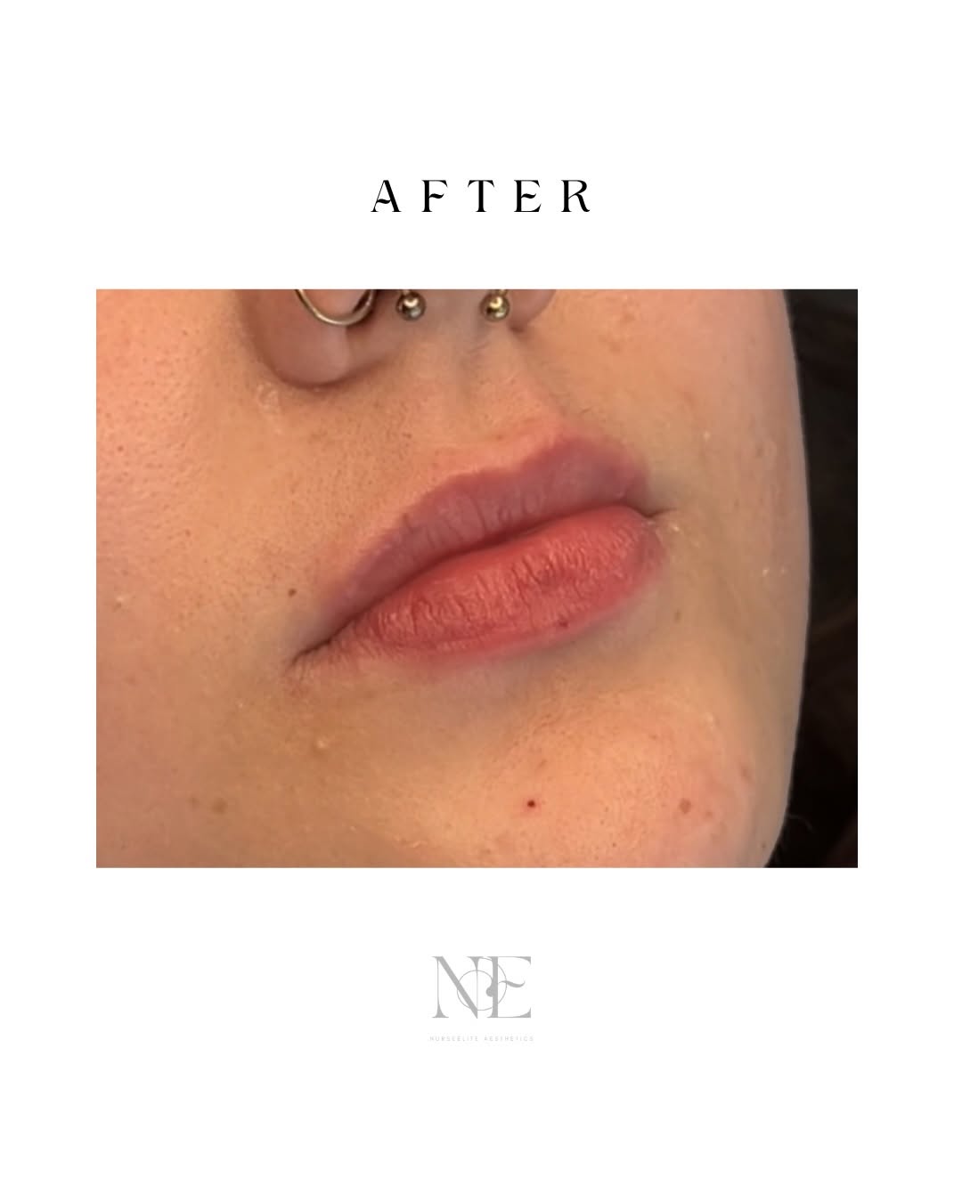 Lip filler — after