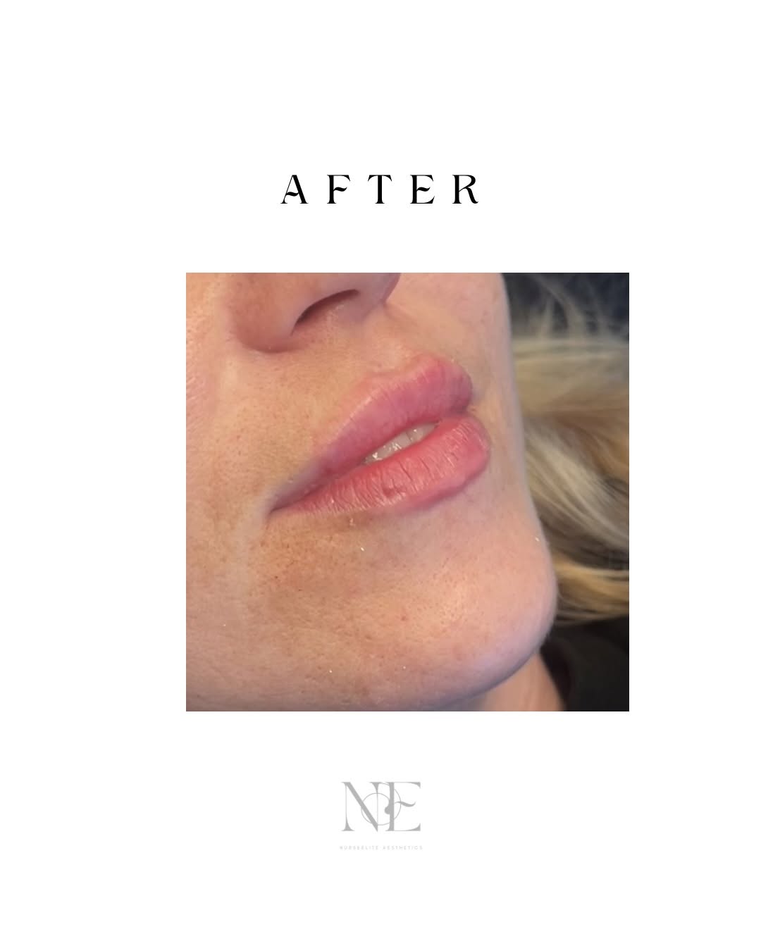 Lip filler — after