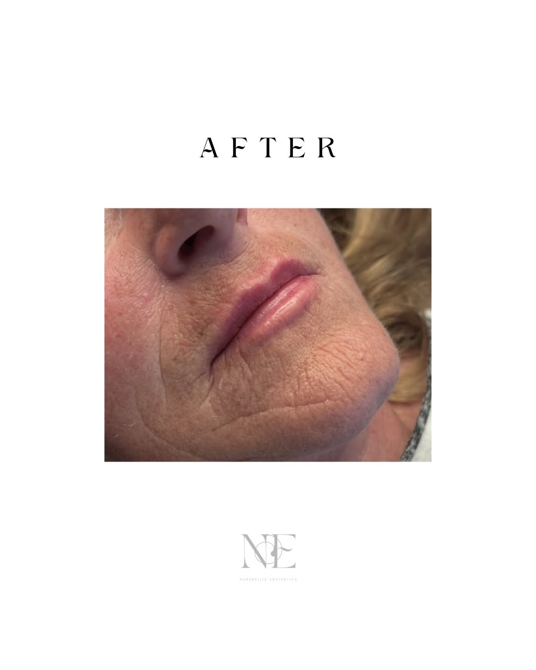 Lip filler — after