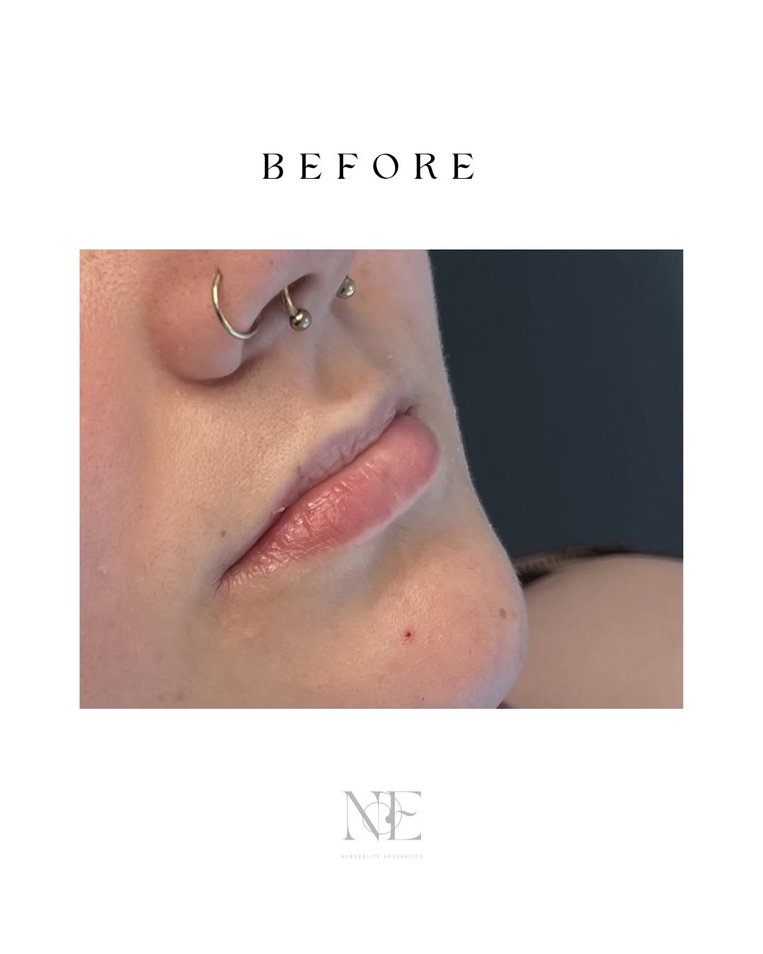 Lip filler — before