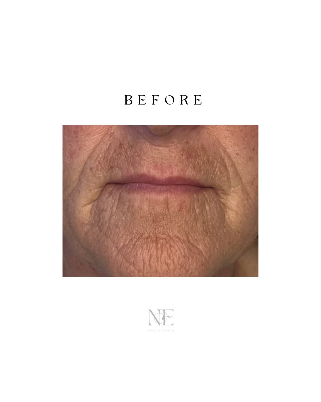Lip filler — before