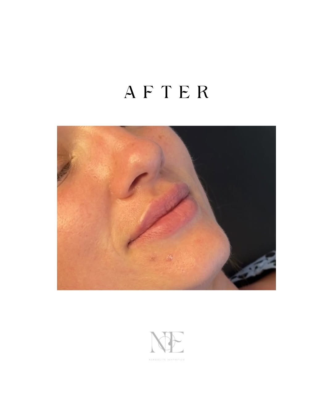 Lip filler — after