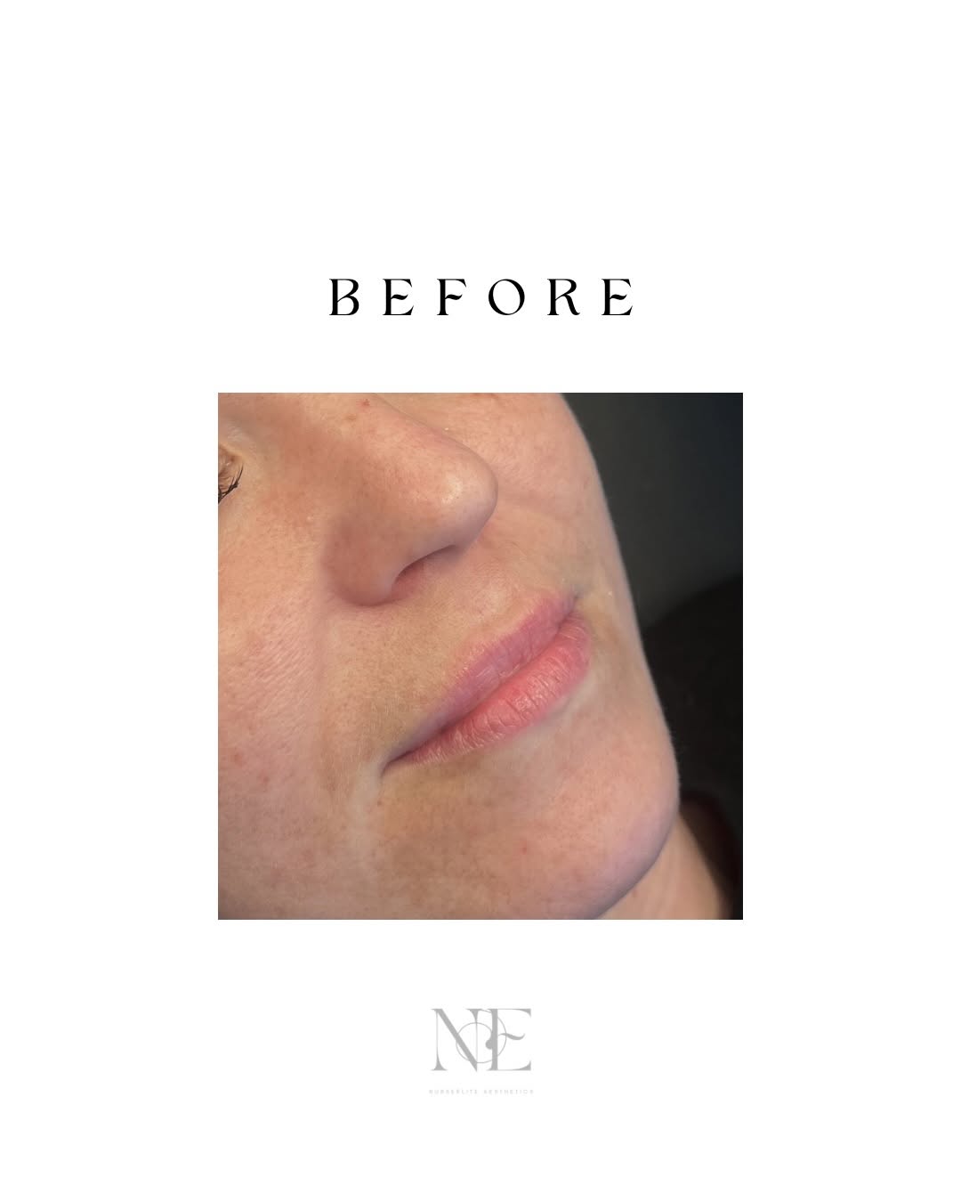 Lip filler — before