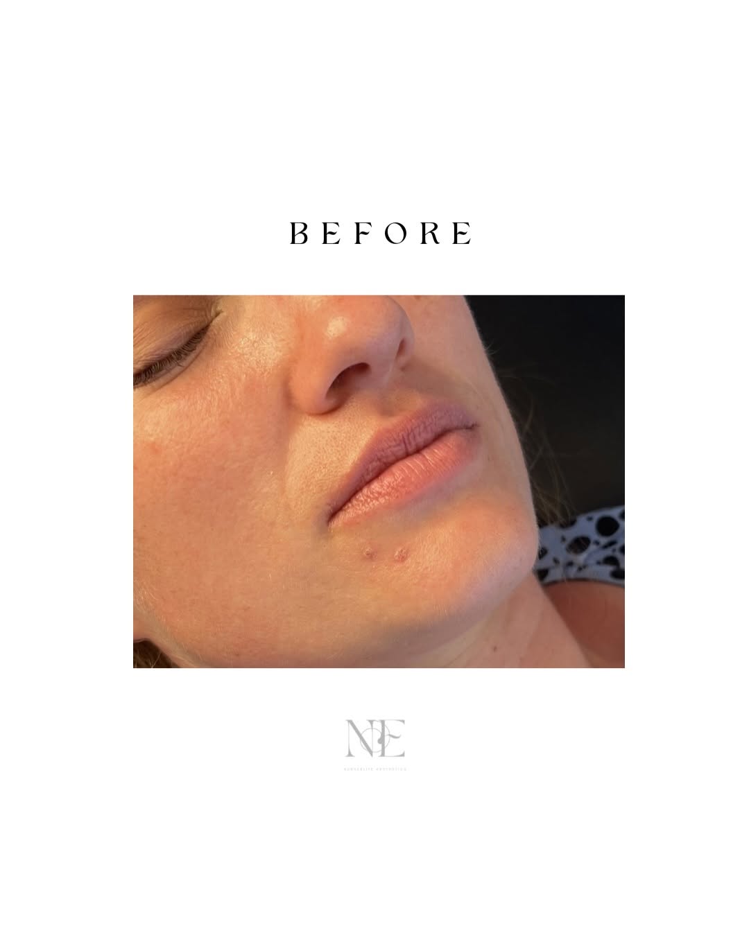 Lip filler — before