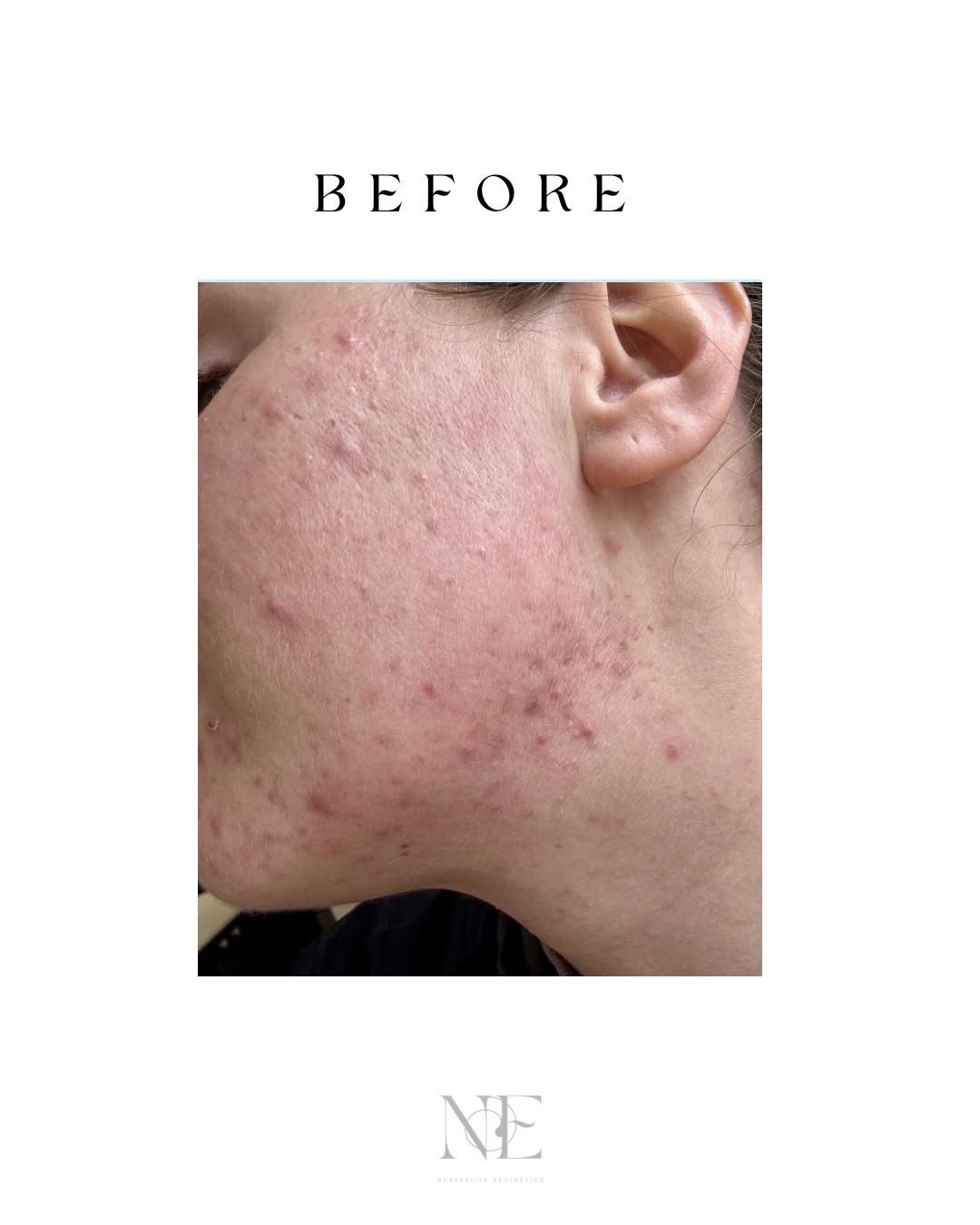 Skin boosters — before