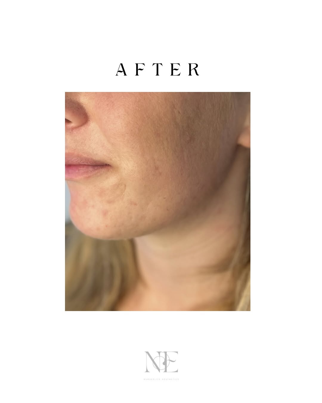 Skin boosters — after
