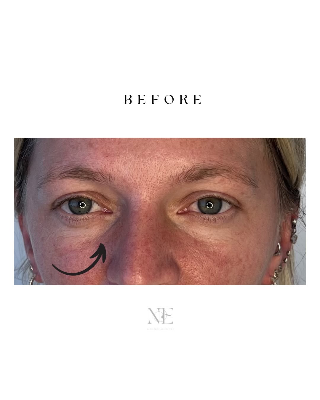 Tear trough filler — before