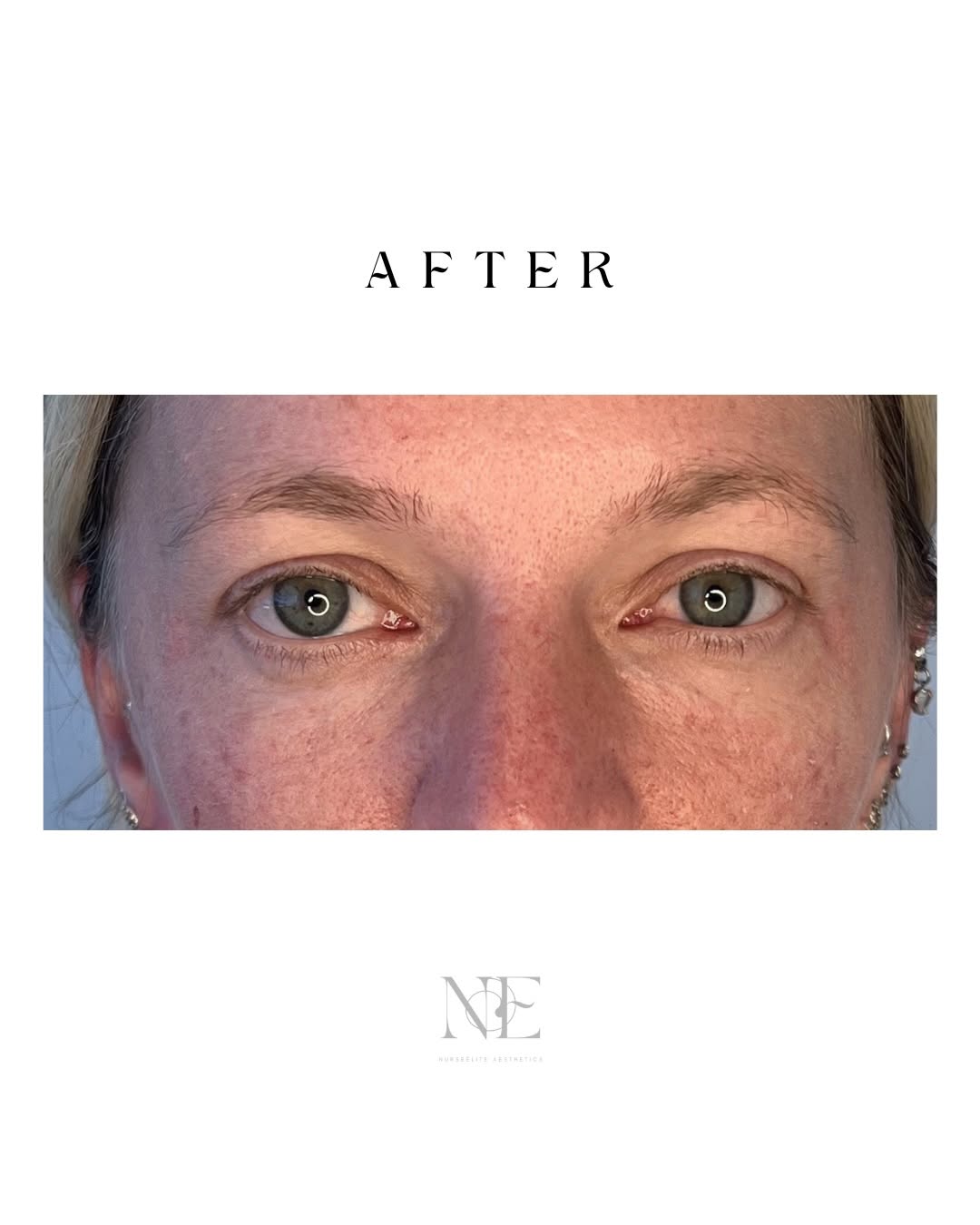 Tear trough filler — after