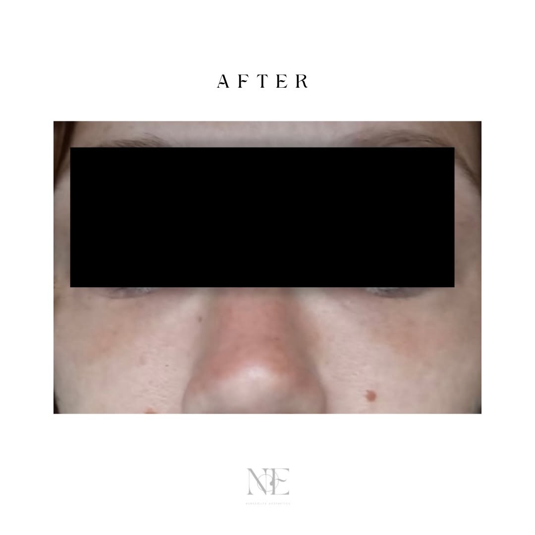 Tear trough filler — after