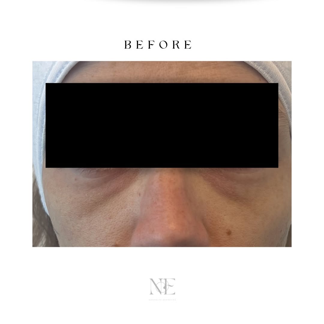 Tear trough filler — before