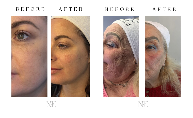 Cheek enhancement before and after results
