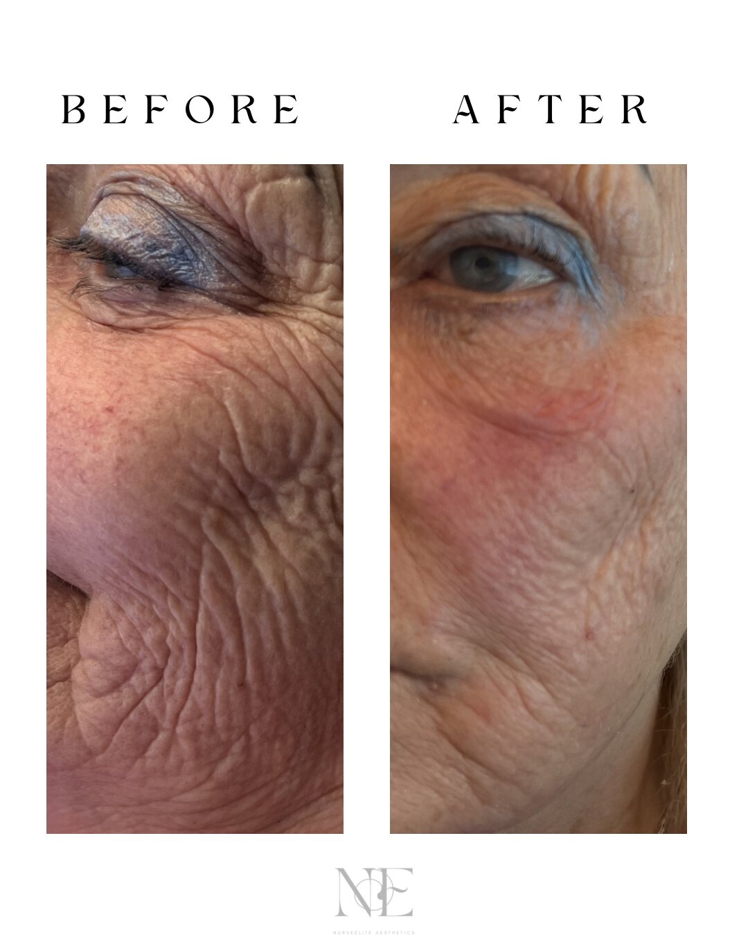 Anti-wrinkle treatment — crow's feet and under-eye before and after