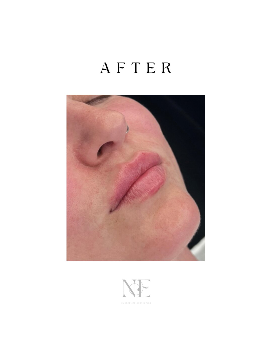 Lip filler — after