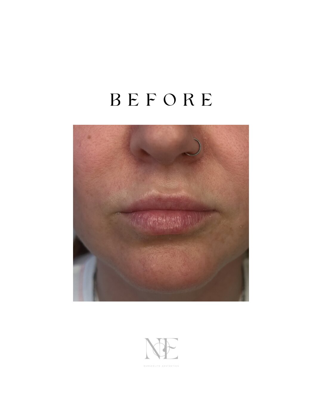 Lip filler — before