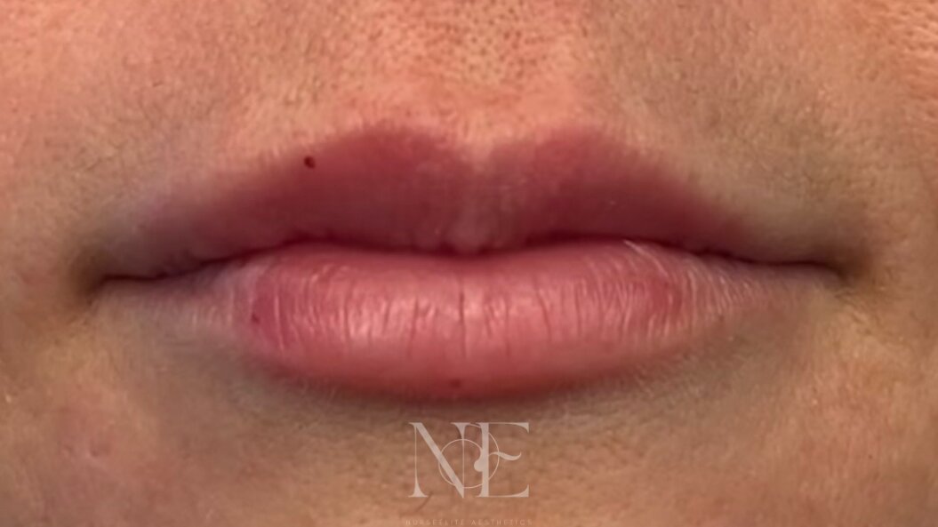 Lip enhancement — before
