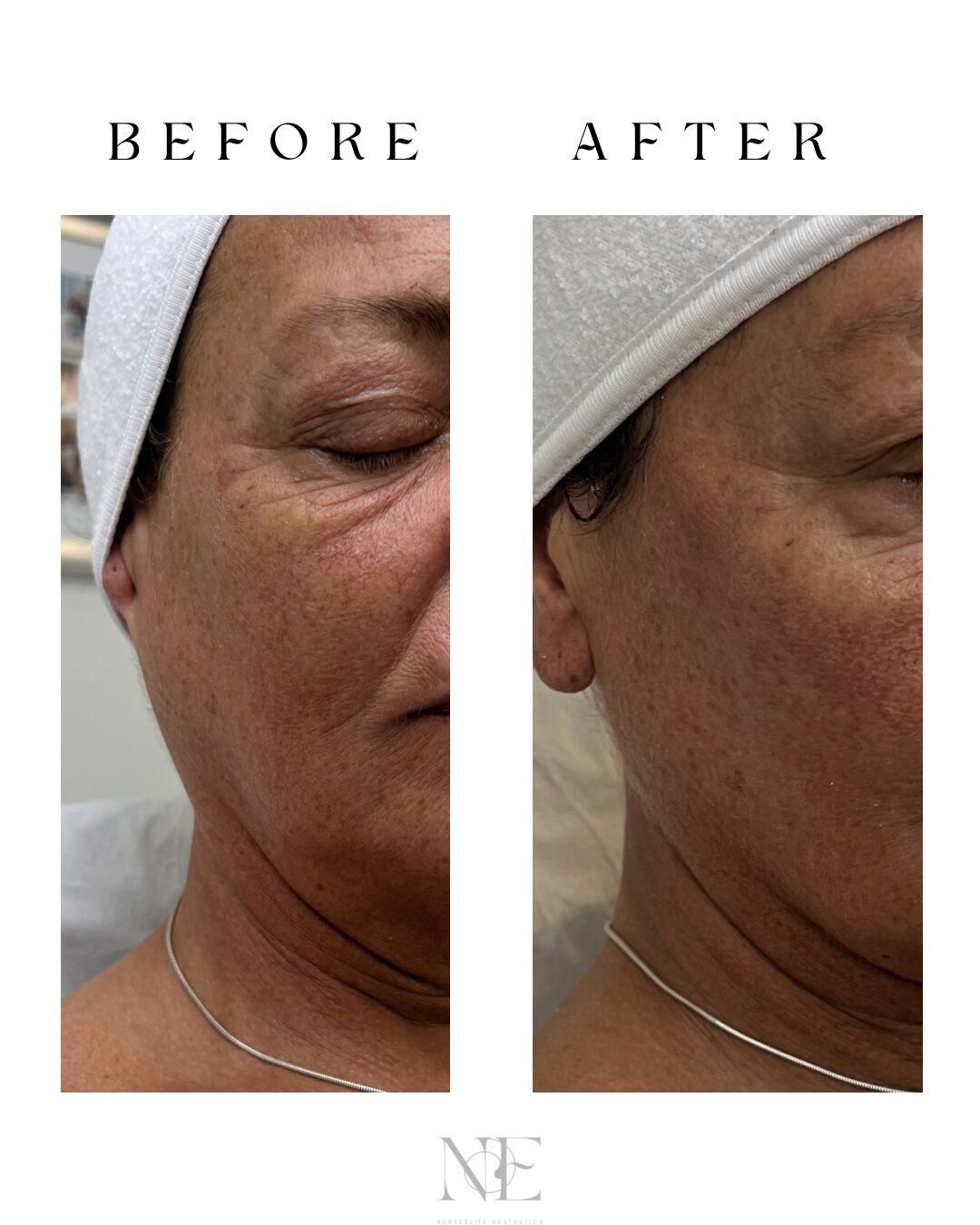 Cheek enhancement before and after results